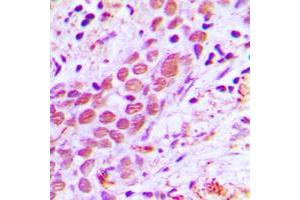 Immunohistochemical analysis of USF2 staining in human breast cancer formalin fixed paraffin embedded tissue section. (USF2 Antikörper  (Center))