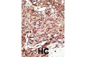 Formalin-fixed and paraffin-embedded human hepatocellular carcinoma tissue reacted with the primary antibody, which was peroxidase-conjugated to the secondary antibody, followed by AEC staining. (PRMT7 Antikörper  (N-Term))