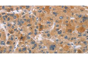 Immunohistochemistry of paraffin-embedded Human liver cancer using CYP4A11 Polyclonal Antibody at dilution of 1:30