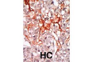 Formalin-fixed and paraffin-embedded human hepatocellular carcinoma tissue reacted with MATK polyclonal antibody  , which was peroxidase-conjugated to the secondary antibody, followed by DAB staining. (MATK Antikörper  (N-Term))