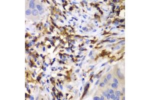 Immunohistochemistry of paraffin-embedded human liver cancer using HCLS1 antibody (ABIN3023093, ABIN3023094, ABIN3023095 and ABIN6219386) at dilution of 1:100 (40x lens). (HCLS1 Antikörper  (AA 1-280))
