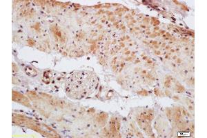 Formalin-fixed and paraffin embedded human gastric carcinoma labeled with Rabbit Anti Phospho-MEF2A (Thr312) Polyclonal Antibody, Unconjugated (ABIN743768) at 1:200 followed by conjugation to the secondary antibody and DAB staining (MEF2A Antikörper  (pThr312))
