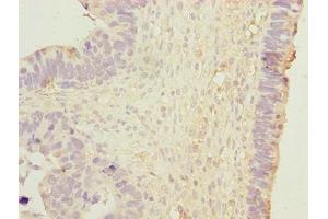 Immunohistochemistry of paraffin-embedded human ovarian cancer using ABIN7150502 at dilution of 1:100 (DNAJB1 Antikörper  (AA 1-340))