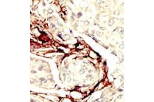 Formalin-fixed and paraffin-embedded human cancer tissue (breast carcinoma) reacted with the primary antibody, which was peroxidase-conjugated to the secondary antibody, followed by DAB staining. (LKB1 Antikörper  (N-Term))