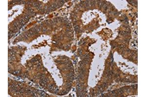 The image on the left is immunohistochemistry of paraffin-embedded Human colon cancer tissue using ABIN7130067(LCMT1 Antibody) at dilution 1/20, on the right is treated with fusion protein. (LCMT1 Antikörper)