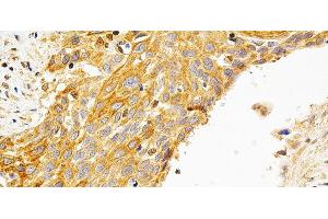 Immunohistochemistry of paraffin-embedded Human esophageal cancer using PRKCE Polyclonal Antibody at dilution of 1:200 (40x lens). (PKC epsilon Antikörper)