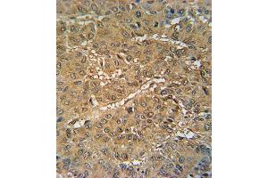 VKORC1 Antibody (N-term) (ABIN652040 and ABIN2840514) immunohistochemistry analysis in formalin fixed and paraffin embedded human hepatocarcinoma followed by peroxidase conjugation of the secondary antibody and DAB staining. (VKORC1 Antikörper  (N-Term))