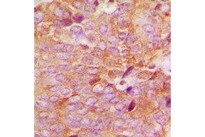 Immunohistochemical analysis of MKK6 staining in human breast cancer formalin fixed paraffin embedded tissue section. (MAP2K6 Antikörper  (N-Term))