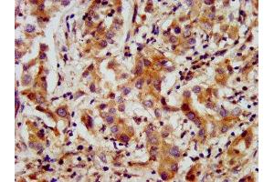 IHC image of ABIN7144009 diluted at 1:200 and staining in paraffin-embedded human liver cancer performed on a Leica BondTM system. (AMMECR1 Antikörper  (AA 146-248))