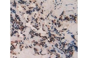 Used in DAB staining on fromalin fixed paraffin- embedded breast cancer tissue (TAF12 Antikörper  (AA 1-161))