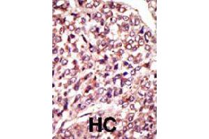 Formalin-fixed and paraffin-embedded human hepatocellular carcinoma tissue reacted with MGAT1 polyclonal antibody  , which was peroxidase-conjugated to the secondary antibody, followed by AEC staining . (MGAT1 Antikörper  (C-Term))
