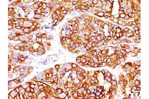 Formalin-fixed, paraffin-embedded human Melanoma stained with MART-1 Rabbit Recombinant Monoclonal Antibody (MLANA/1409R). (Rekombinanter MLANA Antikörper)