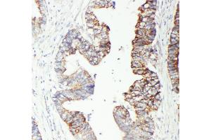 Anti-GST3/GST pi antibody, IHC(P) IHC(P): Human Intestinal Cancer Tissue