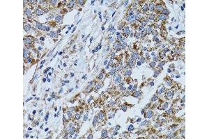 Immunohistochemistry of paraffin-embedded Human lung cancer using ATP5B Polyclonal Antibody at dilution of 1:100 (40x lens).
