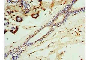 Immunohistochemistry of paraffin-embedded human breast cancer using ABIN7146290 at dilution of 1:100 (CALCB Antikörper  (AA 1-127))
