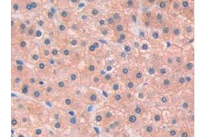 DAB staining on IHC-P; Samples: Human Liver cancer Tissue (IL13 Receptor alpha 1 Antikörper  (AA 203-376))
