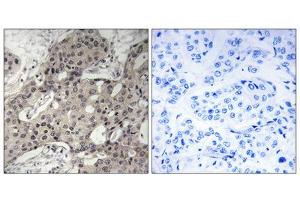 Immunohistochemistry analysis of paraffin-embedded human breast carcinoma tissue using RPL3 antibody. (RPL3 Antikörper  (Internal Region))