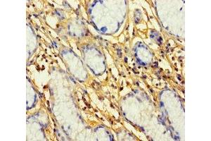 Immunohistochemistry of paraffin-embedded human gastric cancer using ABIN7164709 at dilution of 1:100 (Prokineticin Receptor 1 Antikörper  (AA 1-62))