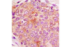 Immunohistochemical analysis of HSPE1 staining in human breast cancer formalin fixed paraffin embedded tissue section. (HSPE1 Antikörper  (Center))