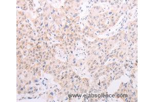 Immunohistochemistry of Human lung cancer using TYR Polyclonal Antibody at dilution of 1:30 (TYR Antikörper)