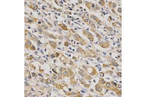 Immunohistochemistry of paraffin-embedded human stomach cancer using ERG antibody at dilution of 1:200 (x400 lens). (ERG Antikörper  (AA 1-280))