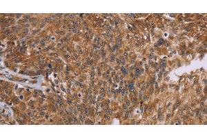 Immunohistochemistry of paraffin-embedded Human ovarian cancer using PPIB Polyclonal Antibody at dilution of 1:45 (PPIB Antikörper)