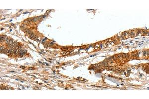 Immunohistochemistry of paraffin-embedded Human colon cancer tissue using COL1A2 Polyclonal Antibody at dilution 1:70 (COL1A2 Antikörper)