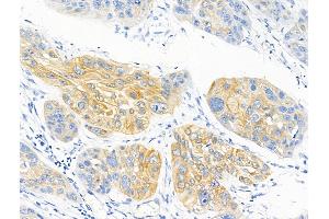 ABIN6255023 and ABIN6267139 at 1/100 staining Human esophageal cancer by IHC-P.