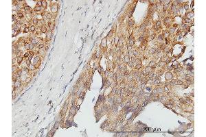 Immunoperoxidase of monoclonal antibody to ASPSCR1 on formalin-fixed paraffin-embedded human breast cancer. (ASPSCR1 Antikörper  (AA 1-553))