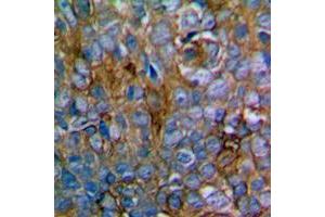 Immunohistochemical analysis of MKK1/2 staining in human prostate cancer formalin fixed paraffin embedded tissue section. (MEK1 Antikörper  (Center))