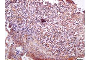 Formalin-fixed and paraffin embedded human lung carcinoma labeled with Anti-VAV3 Polyclonal Antibody, Unconjugated (ABIN706421) at 1:200 followed by conjugation to the secondary antibody and DAB staining (VAV3 Antikörper  (AA 701-800))
