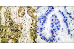 Peptide - +Immunohistochemical analysis of paraffin-embedded human lung carcinoma tissue using Galectin 3 antibody (#C0203). (Galectin 3 Antikörper)