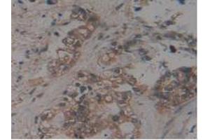 IHC-P analysis of Human Pancreas Cancer Tissue, with DAB staining. (MAPT Antikörper  (AA 130-386))