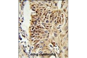 CIRBP Antibody (C-term) (ABIN653083 and ABIN2842680) IHC analysis in formalin fixed and paraffin embedded human lung carcinoma followed by peroxidase conjugation of the secondary antibody and DAB staining. (CIRBP Antikörper  (C-Term))