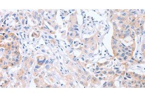 Immunohistochemistry of paraffin-embedded Human lung cancer tissue using CDCA4 Polyclonal Antibody at dilution 1:50 (CDCA4 Antikörper)