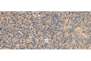 Immunohistochemistry of paraffin-embedded Human cervical cancer tissue using EIF1AX Polyclonal Antibody at dilution of 1:65(x200) (EIF1AX Antikörper)