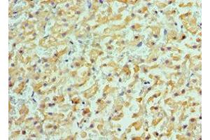 Immunohistochemistry of paraffin-embedded human liver cancer using ABIN7143181 at dilution of 1:100