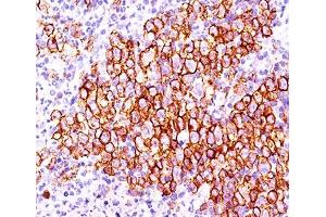 IHC testing of Hodgkin's lymphoma (20X) stained with CD30 antibody (CD30/412). (TNFRSF8 Antikörper)