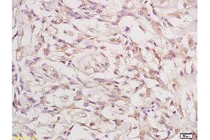 Formalin-fixed and paraffin embedded human cervical carcinoma labeled with Anti-Phospho-FGFR1+FGFR2 (Tyr463) Polyclonal Antibody, Unconjugated (ABIN758197) at 1:200 followed by conjugation to the secondary antibody and DAB staining (FGFR1/FGFR2 Antikörper  (pTyr463, pTyr466))