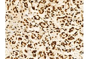 Phospho-Hexokinase 1 (Tyr732) Antibody at 1/100 staining Human pancreatic cancer and adjacent nomal tissues by IHC-P. (Hexokinase 1 Antikörper  (pTyr732))