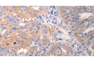 Immunohistochemistry of paraffin-embedded Human breast cancer tissue using CK-6A/B/C Polyclonal Antibody at dilution 1:50 (CK-6A/B/C Antikörper)
