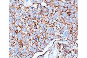 IHC testing of human breast cancer stained with HCAM antibody (156-3C11). (CD44 Antikörper)