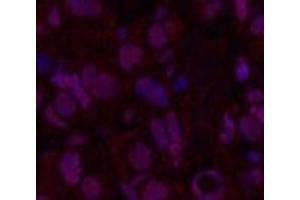 Immunofluorescence analysis of Human breast cancer tissue using Oct-1/2 Monoclonal Antibody at dilution of 1:200. (Oct-1/2 Antikörper)