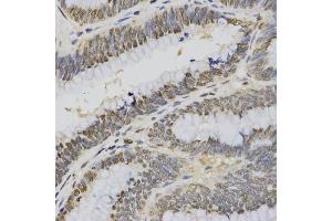 Immunohistochemistry of paraffin-embedded human rectal cancer using Trimethyl-Histone H3-K4 antibody (ABIN5969804) at dilution of 1/200 (40x lens). (Histone 3 Antikörper  (H3K4me3))