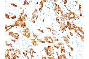 Formalin-fixed, paraffin-embedded human Breast Carcinoma stained with HSP27 Monoclonal Antibody (HSPB1/774) (HSP27 Antikörper)