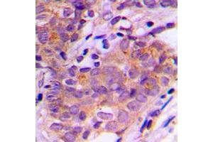 Immunohistochemical analysis of SGK1/2 staining in human breast cancer formalin fixed paraffin embedded tissue section. (SGK1/2 (Center) Antikörper)