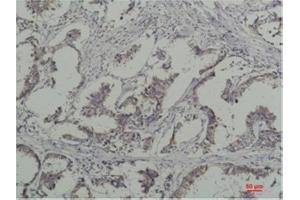 Immunohistochemical analysis of paraffin-embedded Human Breast Caricnoma using PhosphotyrosineMouse mAb diluted at 1:200. (Phosphotyrosine Antikörper)