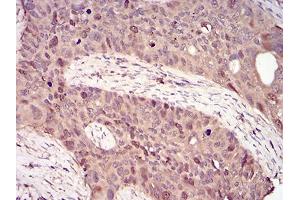 Immunohistochemical analysis of paraffin-embedded cervical cancer tissues using CCNA2 mouse mAb with DAB staining.
