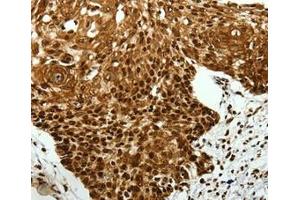Immunohistochemical analysis of paraffin-embedded Human cervical cancer tissue using at dilution 1/40. (SCN11A Antikörper  (Internal Region))