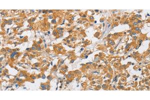 Immunohistochemistry of paraffin-embedded Human thyroid cancer using ARHGAP15 Polyclonal Antibody at dilution of 1:50 (ARHGAP15 Antikörper)
